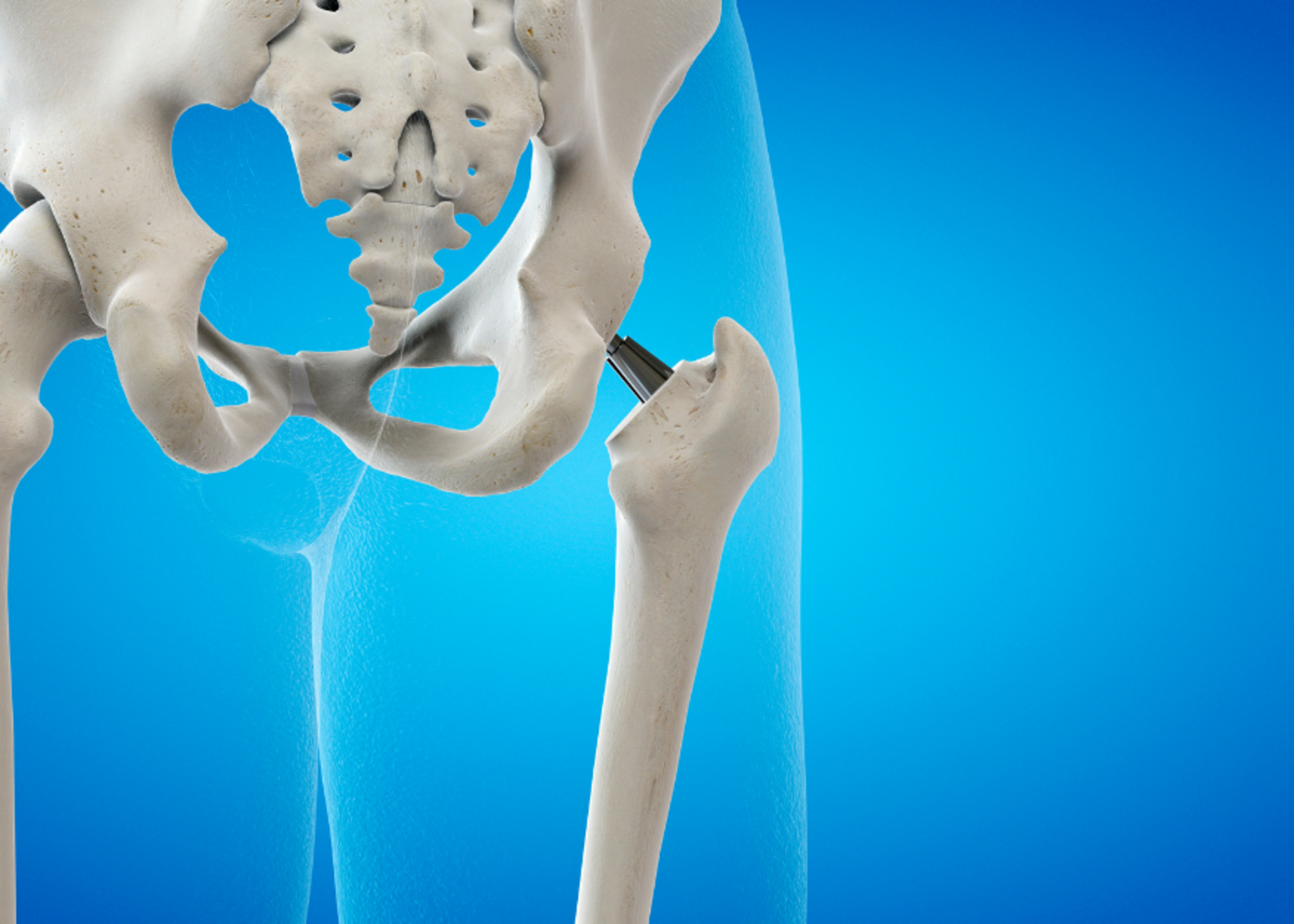 Hip Replacement