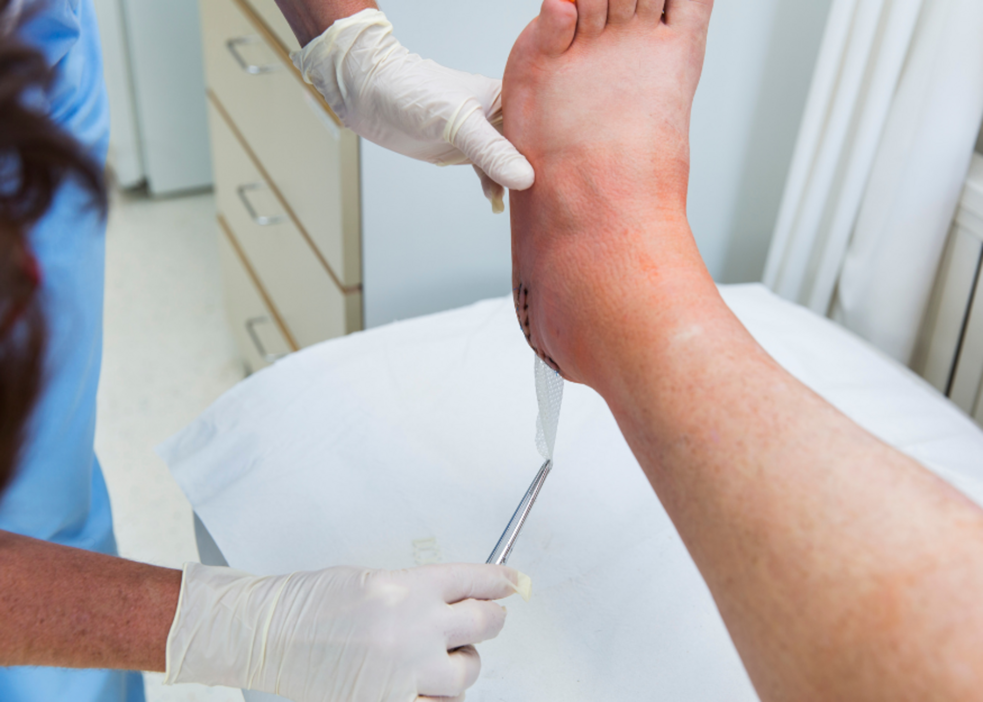 Achilles Tendon Injuries Treatment