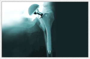 Total Hip Replacement Information - Dr Shreedhar Archik