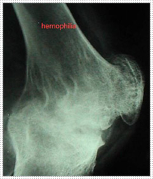Total Knee Replacement in a Case of Haemophilia - Dr Shreedhar Archik
