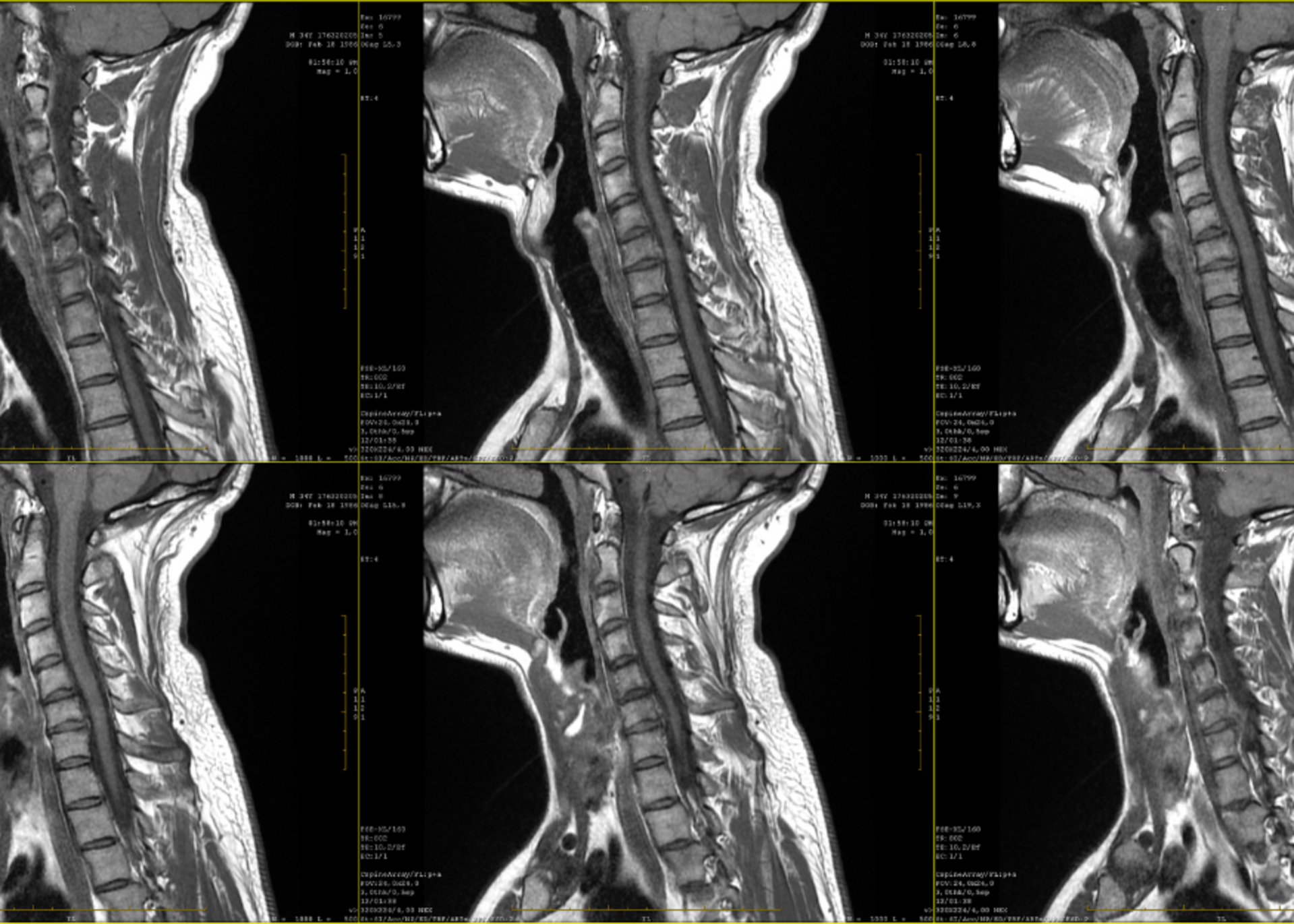 Radiculopathy Treatment
