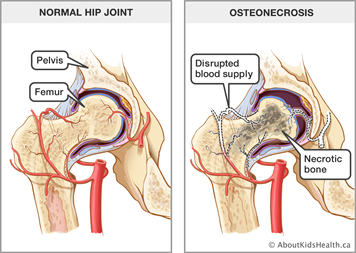 Bone Death Syndrome Treatment Mumbai | Dr. Shreedhar Archik