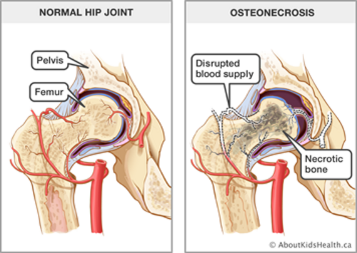 Bone Death Syndrome Treatment Mumbai | Dr. Shreedhar Archik|Dr Shreedhar Archik|Dadar West,Mumbai