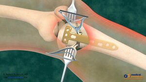 High Tibial Osteotomy : A Knee Preserving Surgery | Dr. Shreedhar Archik