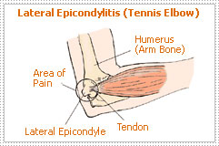 Lateral Epicondylitis (Tennis Elbow) - Dr Shreedhar Archik